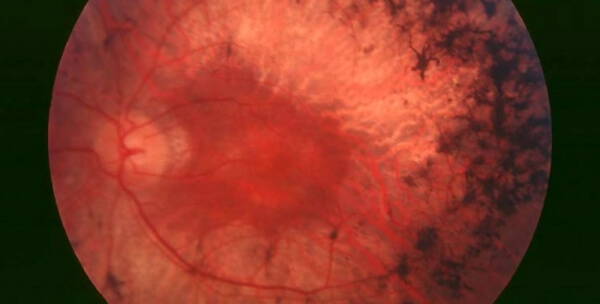 Retinitis Pigmentosa – New Treatments