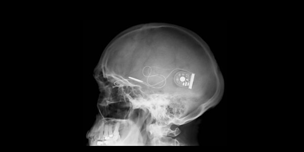 Retinitis pigmentosa. And a new groundbreaking method!