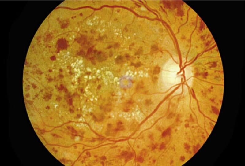 Diabetic Retinopathy