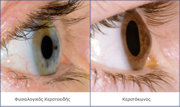 Corneal