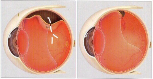 Retinal Detachment