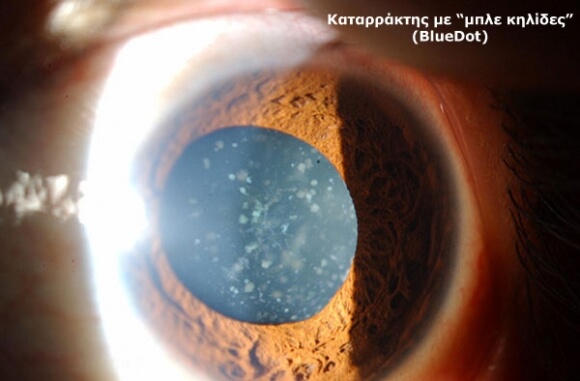 Cataract Surgery