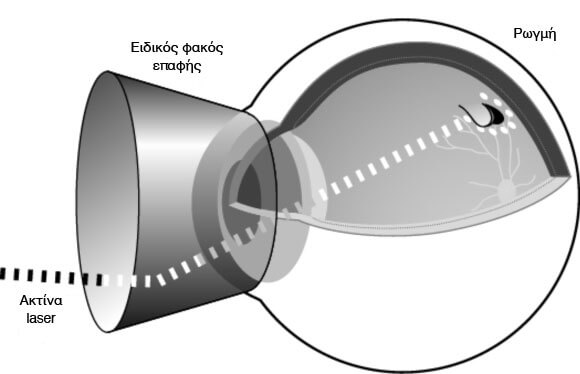 Laser Treatment