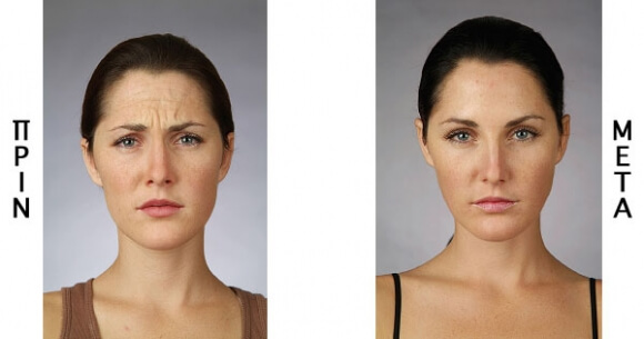 Facial Botox