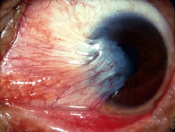  Pterygium Surgery
