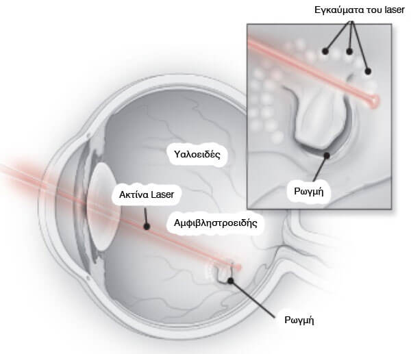 Vitreous Diseases