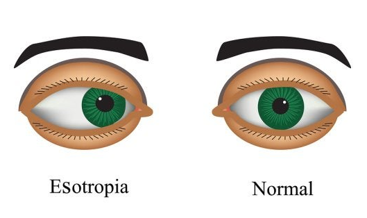 Strabismus